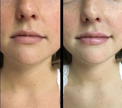 Lip injections omaha A lip augmentation procedure increases the lip fullness through the use of lip fillers